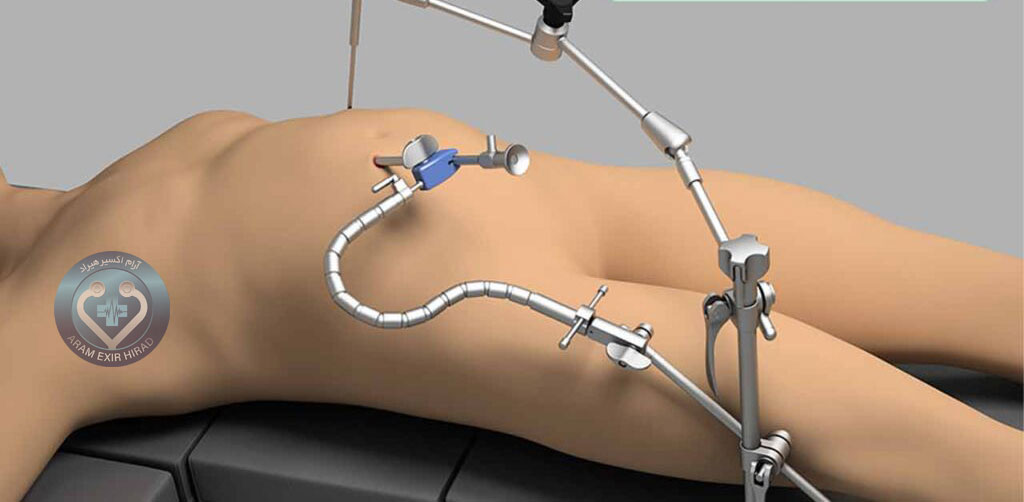 انواع لیگاشور