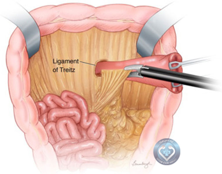 معرفی انواع لیگاشور لاپاراتومی 4 مدل اصلی 1 لیگاشور لاپاراتومی