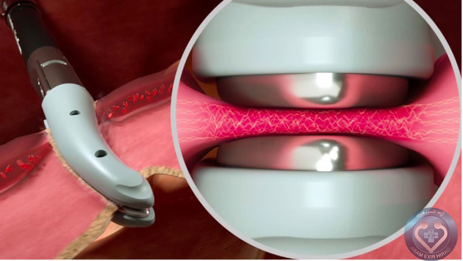 هندپیس لیگاشور چیست ؟ 1 انواع لیگاشور