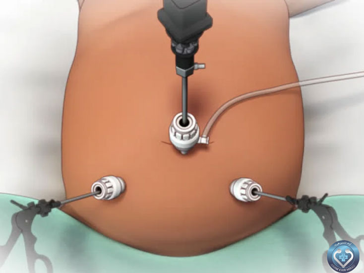 جراحی لاپاراسکوپی چیست ؟ 2 جراحی لاپاراسکوپی