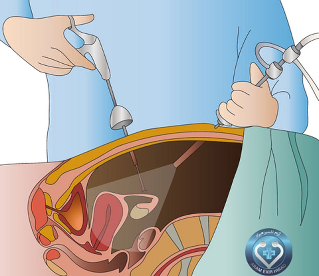 تجهیزات پزشکی 70 جراحی لاپاراسکوپی